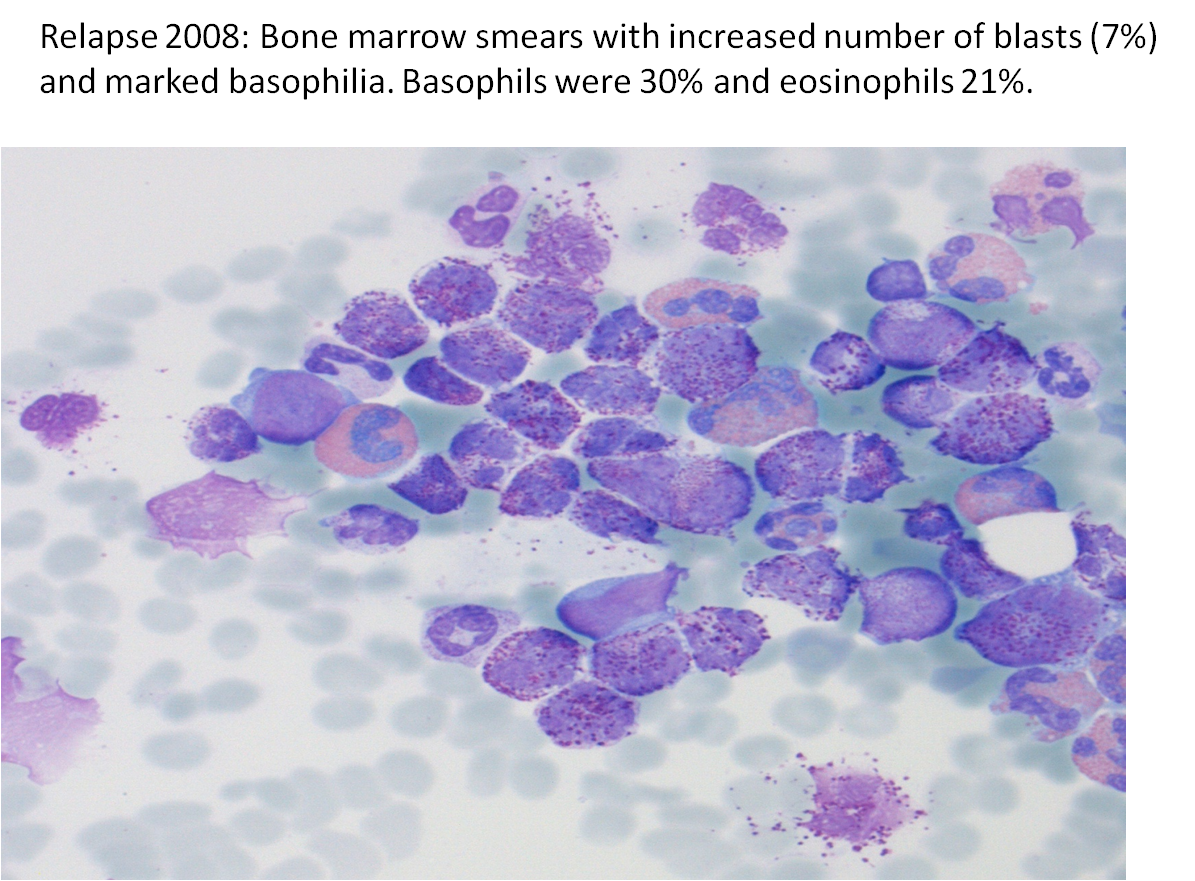 Fig 7. Bone marrow smear at relapse